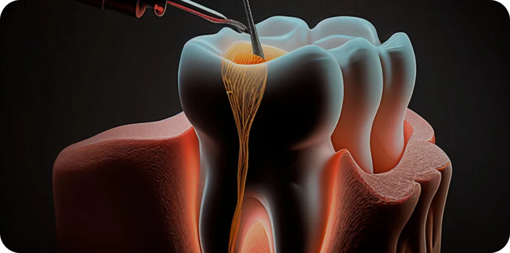 Conseils sur endodontie