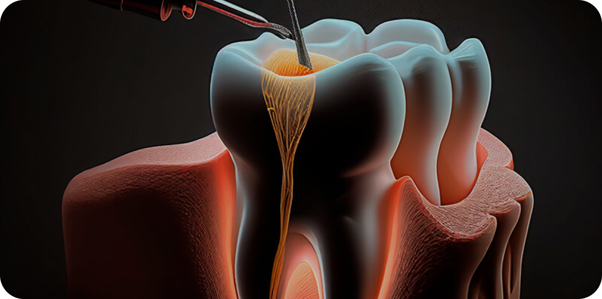 conseils sur endodontie à Garches Dr Luna Maeva