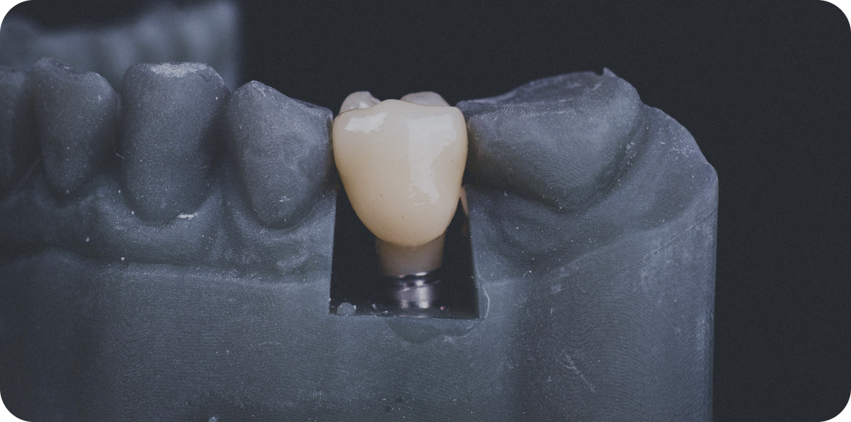 conseils sur implant à Garches Dr Luna Maeva