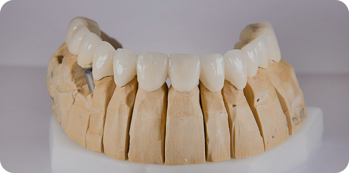 conseils sur protheses à Garches Dr Luna Maeva