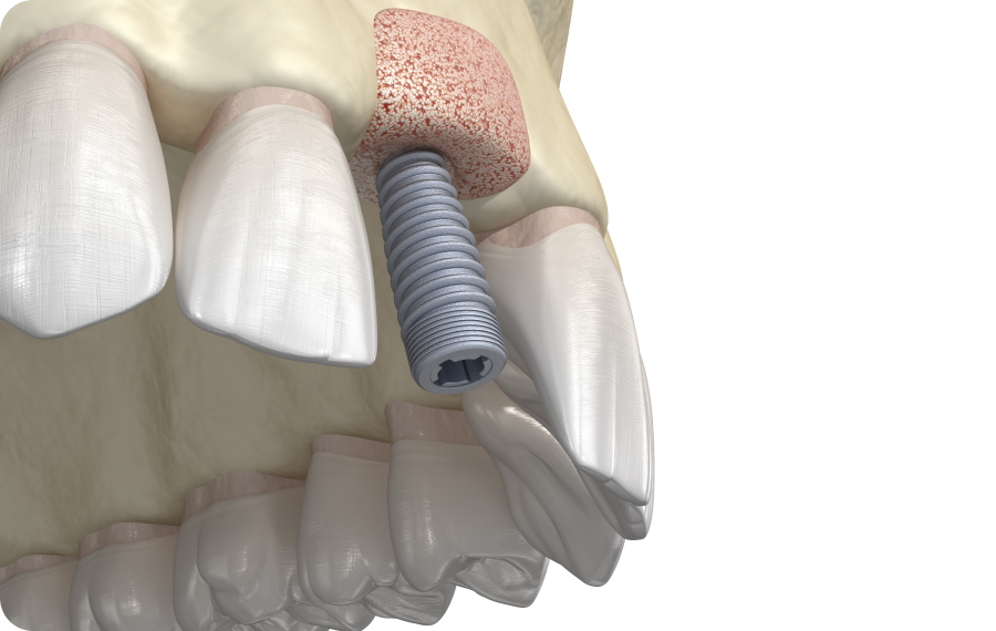 Régénération osseuse