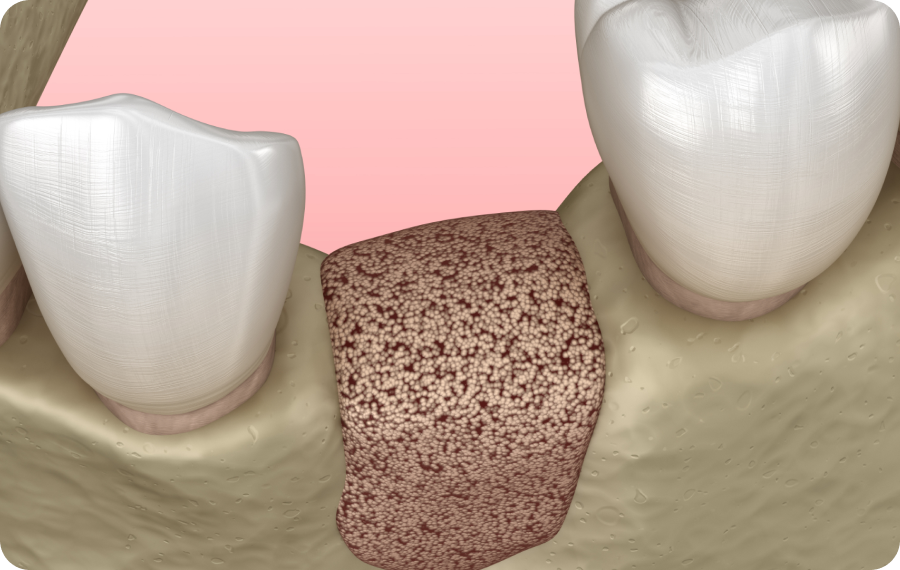 Régénération osseuse
