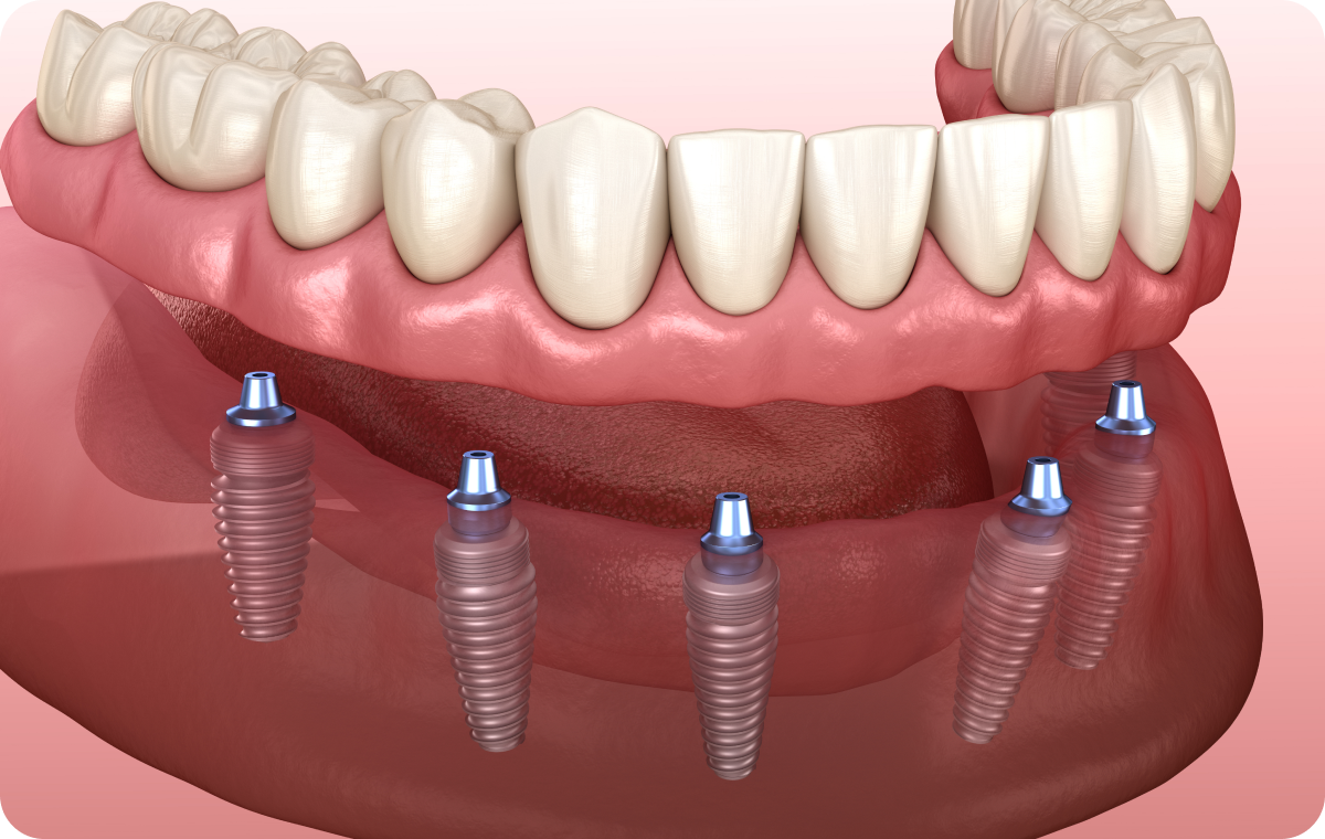 Prothèse implanto portée