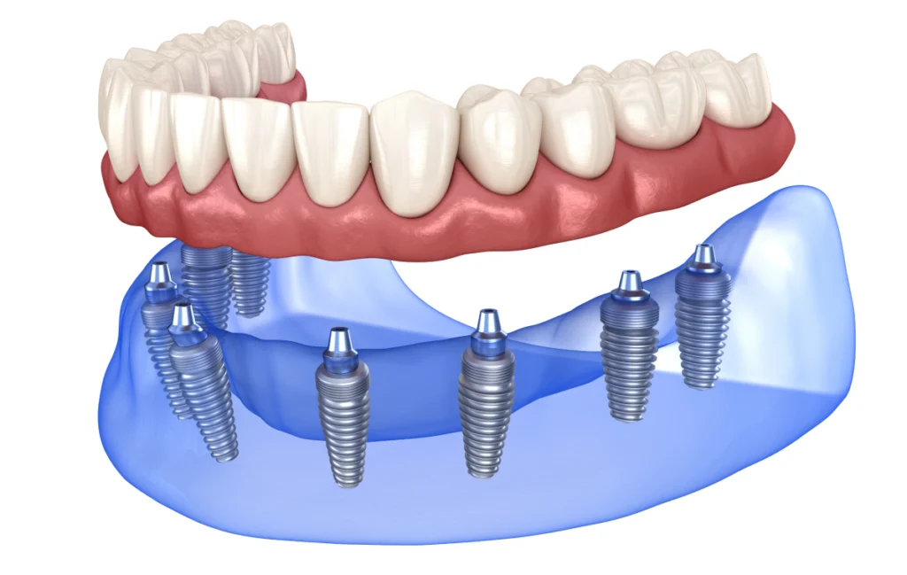 Prothèse implanto portée
